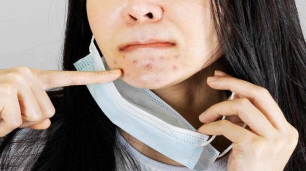 Dermatologista Alerta Sobre Erupção Cutânea Causada Pelo Uso De Máscaras Maskne E Problemas Bucais
