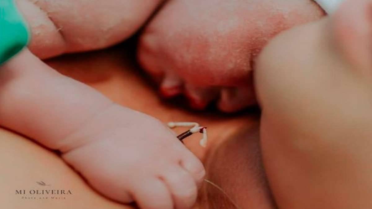 No Rio De Janeiro, Bebê Nasce Segurando DIU Usado Pela Mãe