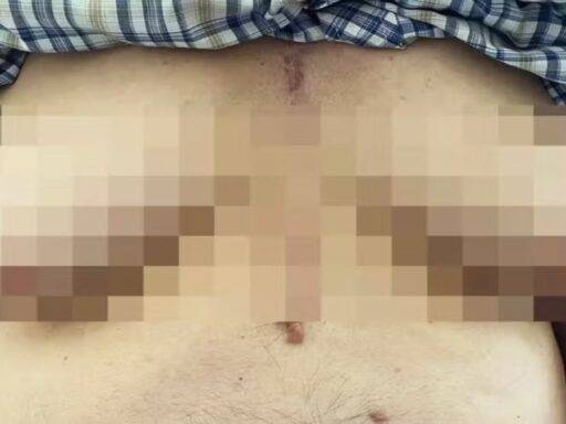 Idoso Desenvolve 'seios' Após Tomar Medicamento Para Condição Cardíaca