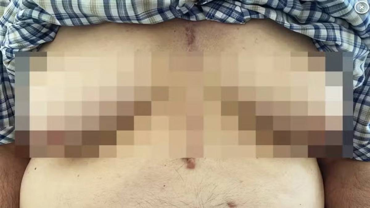 Idoso Desenvolve 'seios' Após Tomar Medicamento Para Condição Cardíaca