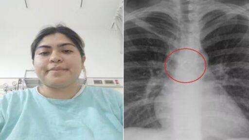 Monica Deyanira Cabrera Barajas Descobriu Que Piercing No Nariz Que Havia Sumido Estava Alojado Nos Pulmões