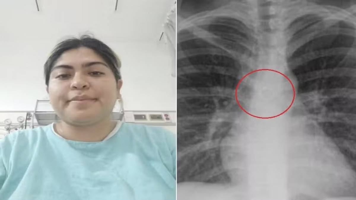 Monica Deyanira Cabrera Barajas Descobriu Que Piercing No Nariz Que Havia Sumido Estava Alojado Nos Pulmões