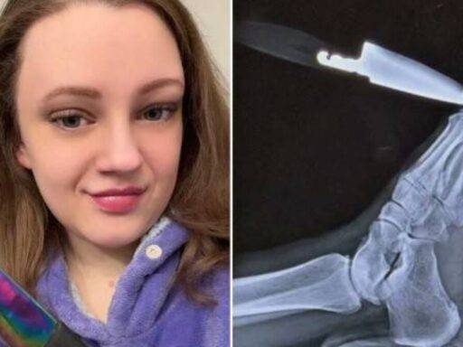 Faca cravada no pé revela cisto ovariano grave e salva vida de mulher nos EUA