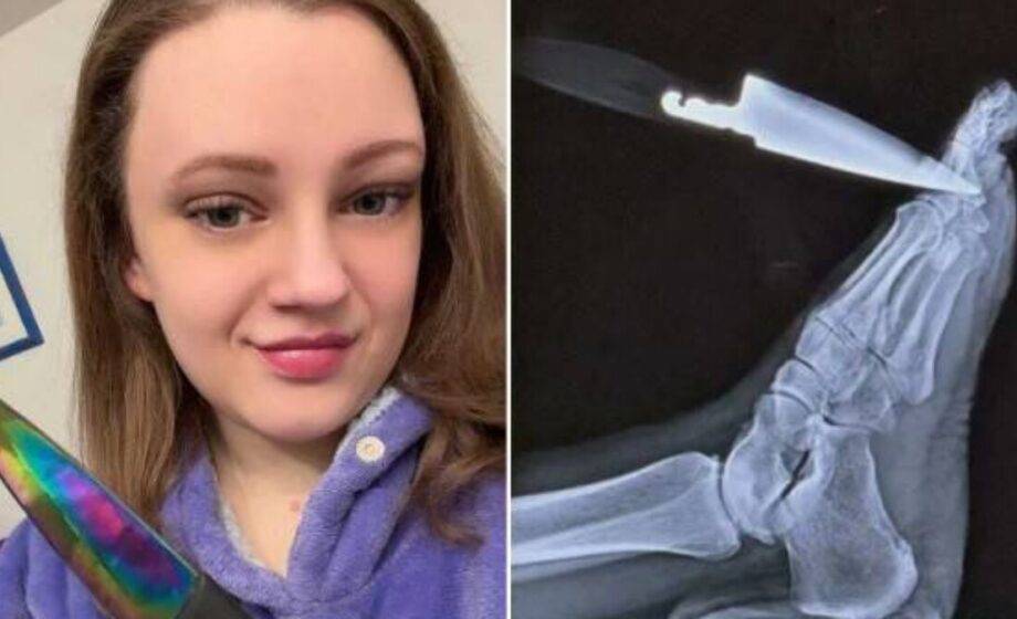 Faca cravada no pé revela cisto ovariano grave e salva vida de mulher nos EUA