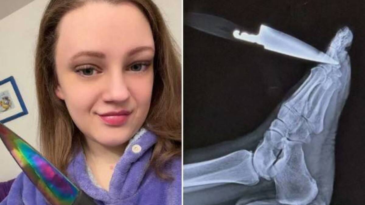 Faca cravada no pé revela cisto ovariano grave e salva vida de mulher nos EUA