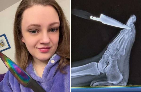 Faca cravada no pé revela cisto ovariano grave e salva vida de mulher nos EUA