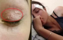Jovem russa convive com parasita de 15 centímetros no rosto durante um ano inteiro