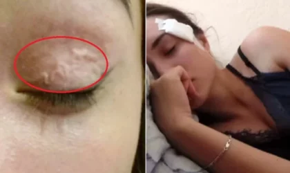 Jovem russa convive com parasita de 15 centímetros no rosto durante um ano inteiro